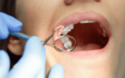 Dental Sealants for Adults: Why They’re a Smart Choice